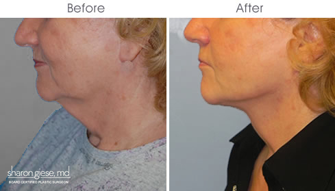 necklift surgery before after nyc
